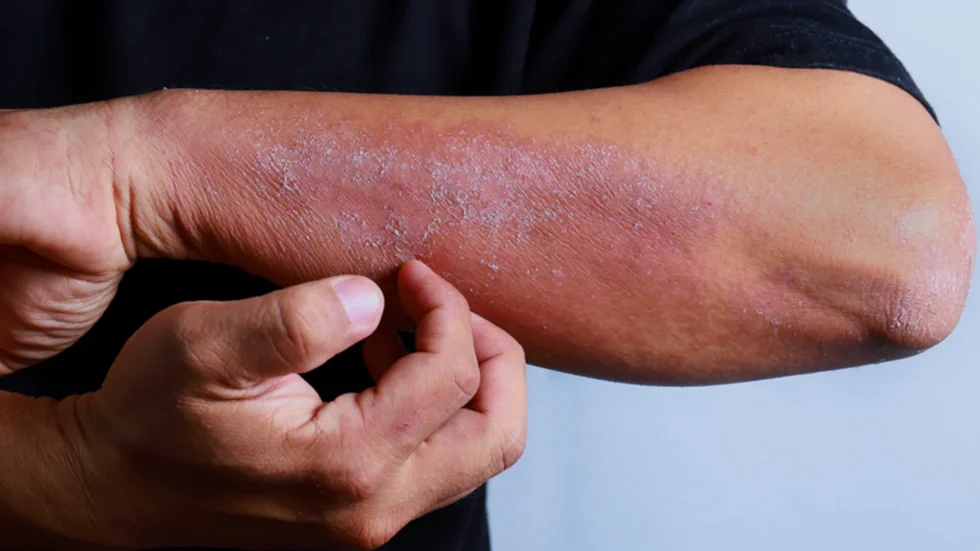 How to Treat an Allergic Reaction to a Skincare Product 980x551 1