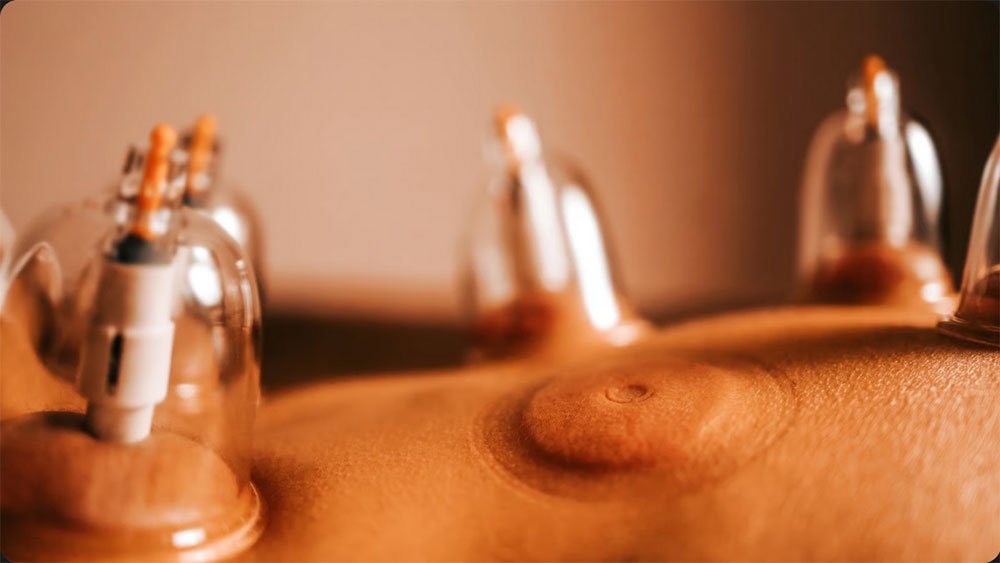 Hijama